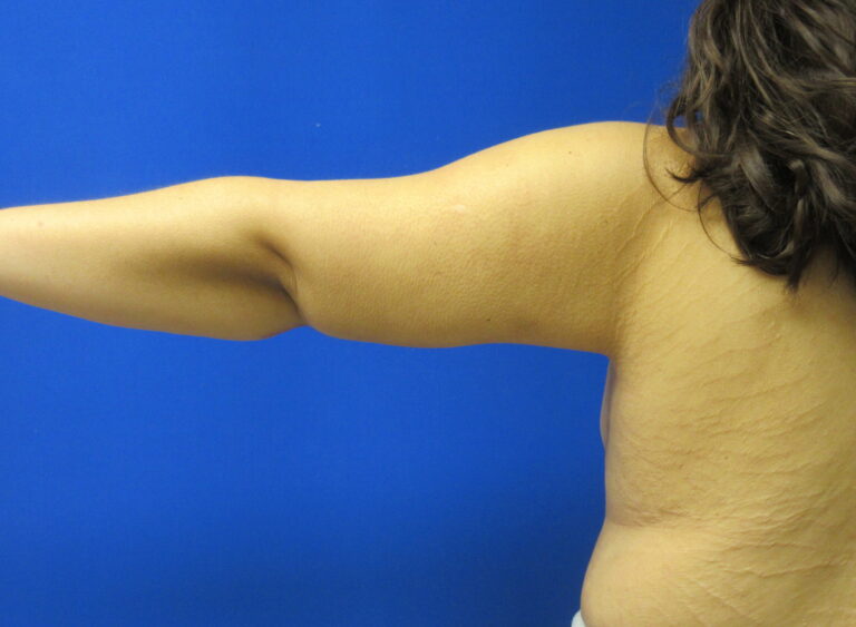 After Image: Arm Lift / Brachioplasty Patient 13 - back