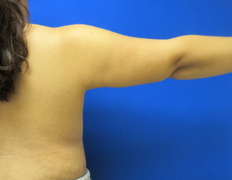 After Image: Arm Lift / Brachioplasty Patient 13 - back