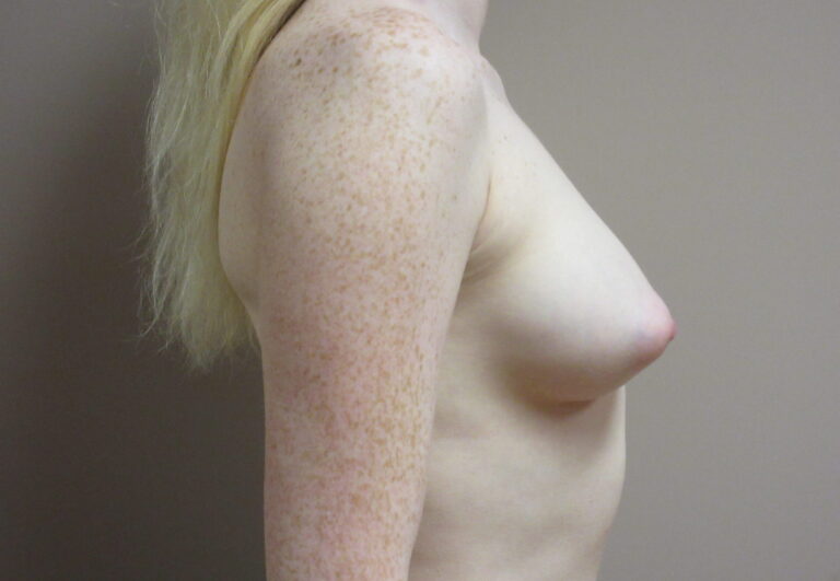 Before Image: Breast Augmentation Patient 171 - right-side