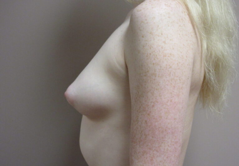 Before Image: Breast Augmentation Patient 171 - left-side