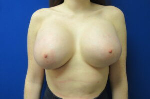 Before Image: Breast Implant Remove and Replace Patient 15