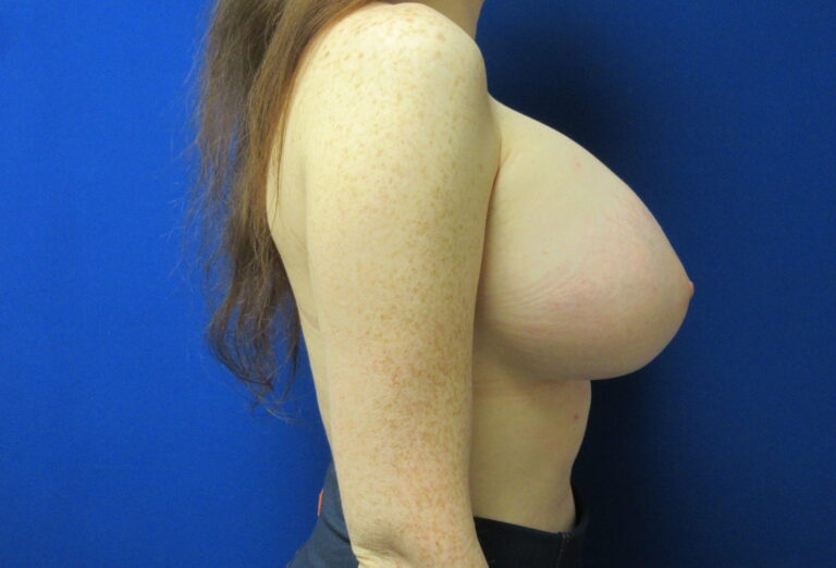 Before Image: Breast Implant Remove and Replace Patient 15 - right-side