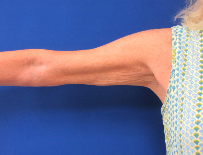 Before Image: Arm Lift / Brachioplasty Patient 15 - front