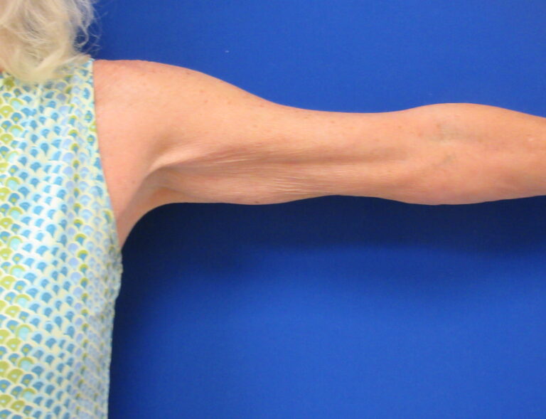 Before Image: Arm Lift / Brachioplasty Patient 15 - front