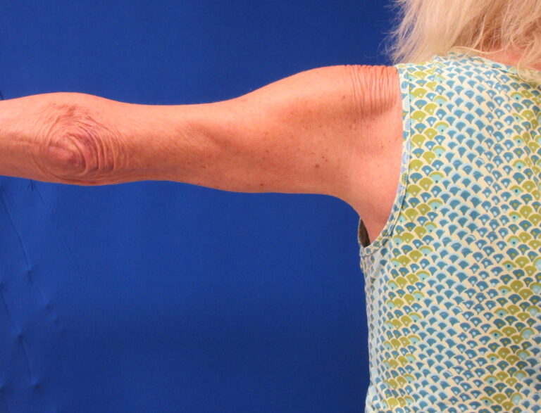 Before Image: Arm Lift / Brachioplasty Patient 15 - back