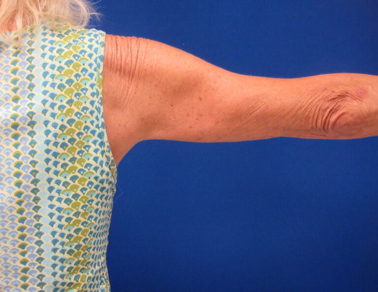 Before Image: Arm Lift / Brachioplasty Patient 15 - back