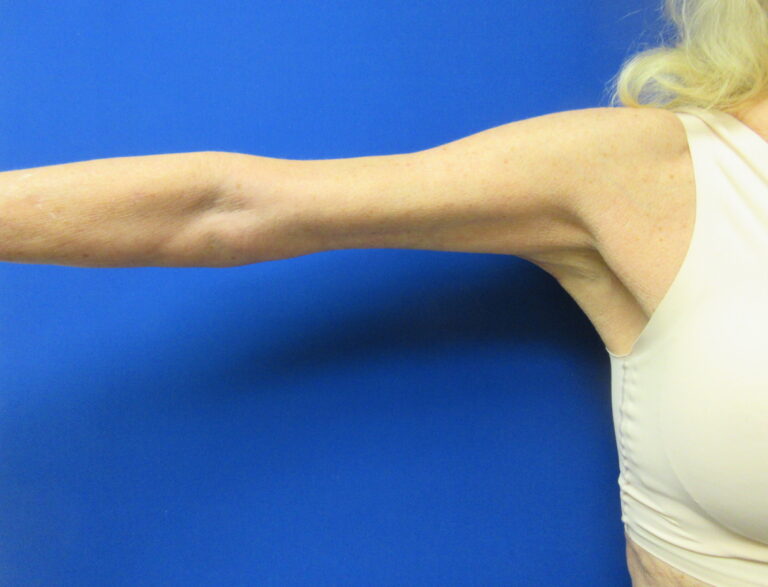 After Image: Arm Lift / Brachioplasty Patient 15 - front