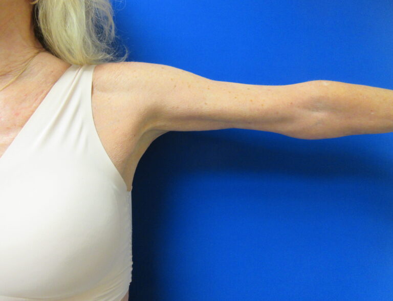 After Image: Arm Lift / Brachioplasty Patient 15 - front