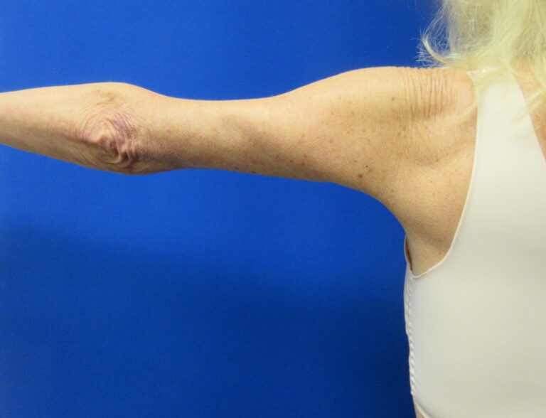 After Image: Arm Lift / Brachioplasty Patient 15 - back