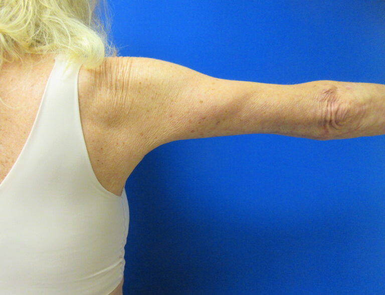 After Image: Arm Lift / Brachioplasty Patient 15 - back