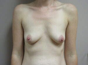 Before Image: Breast Augmentation Patient 172