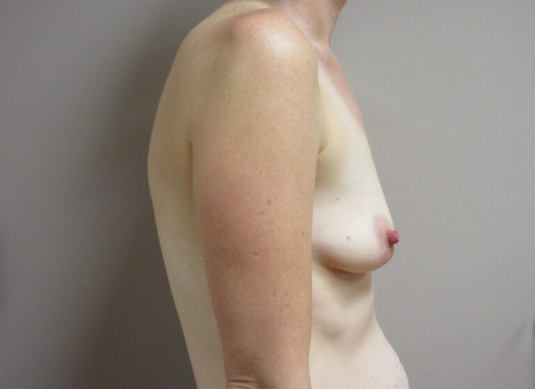 Before Image: Breast Augmentation Patient 172 - right-side
