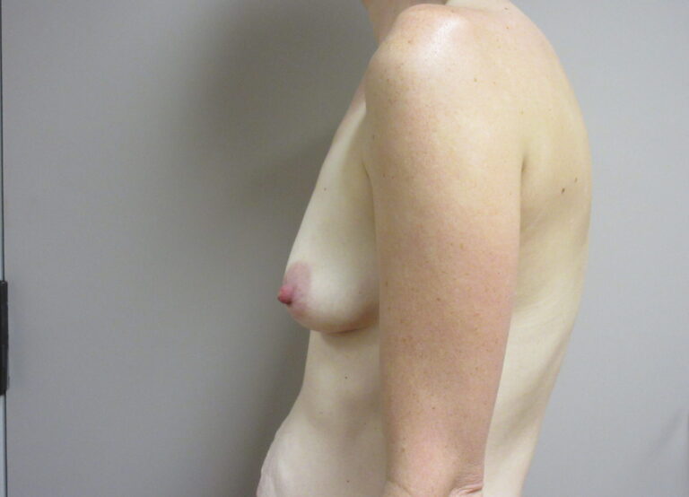 Before Image: Breast Augmentation Patient 172 - left-side