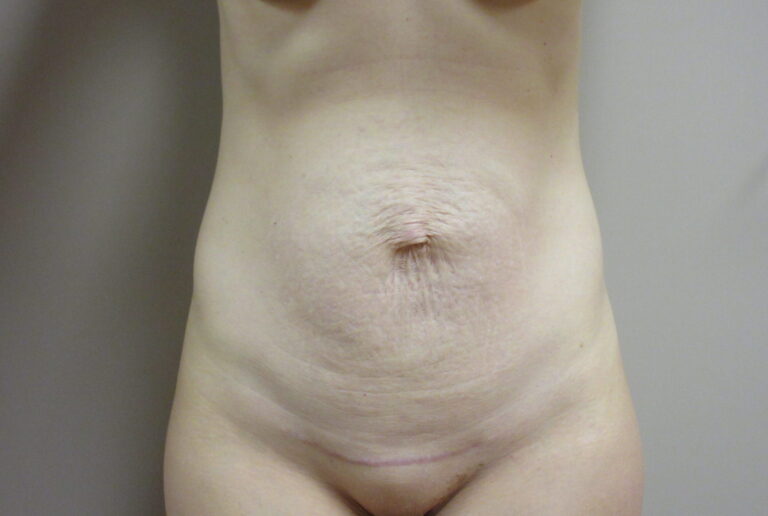 Before Image: Tummy Tuck Patient 63 - front