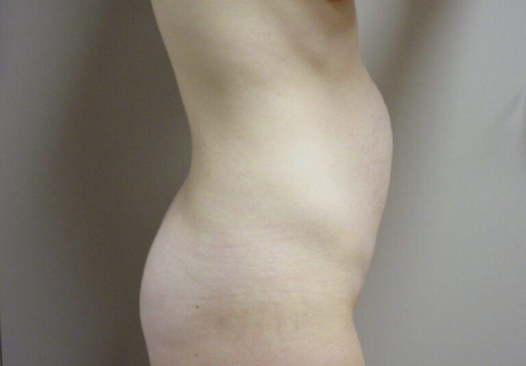 Before Image: Tummy Tuck Patient 63 - right-side