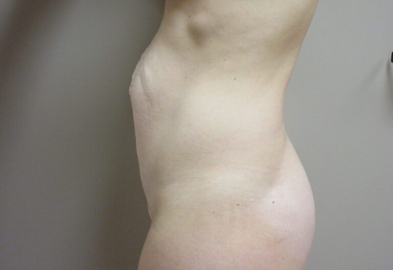 Before Image: Tummy Tuck Patient 63 - left-side
