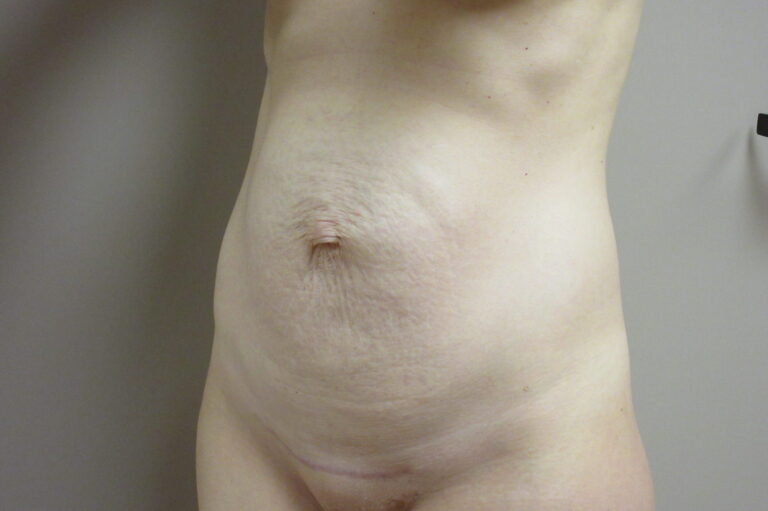 Before Image: Tummy Tuck Patient 63 - left-front-oblique