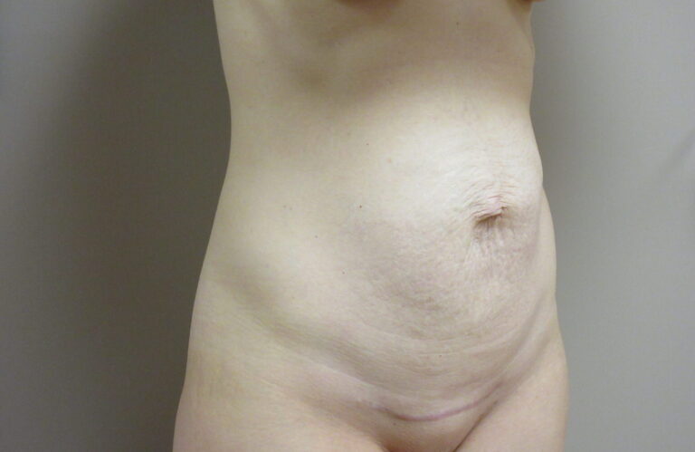 Before Image: Tummy Tuck Patient 63 - right-front-oblique
