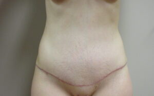 After Image: Tummy Tuck Patient 63