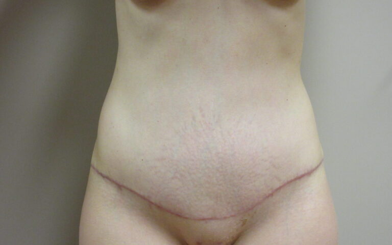 After Image: Tummy Tuck Patient 63 - front