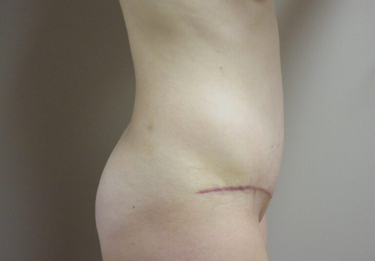 After Image: Tummy Tuck Patient 63 - right-side