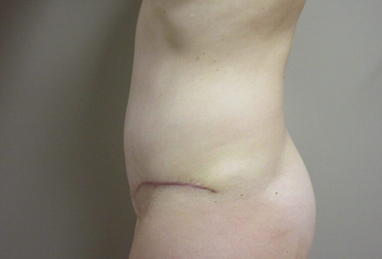 After Image: Tummy Tuck Patient 63 - left-side