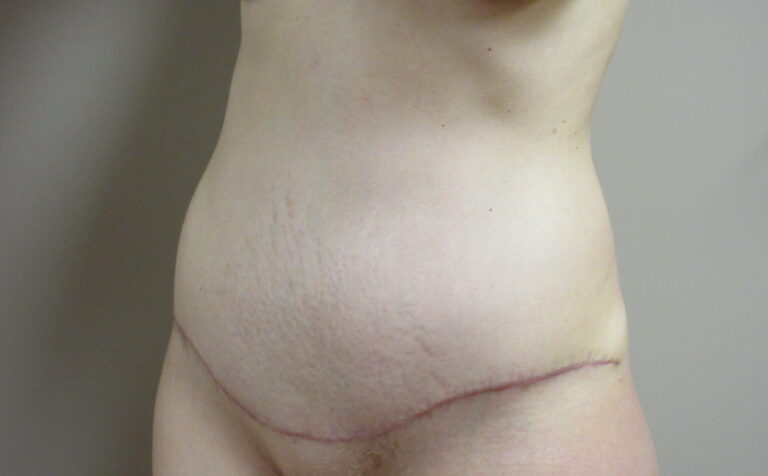 After Image: Tummy Tuck Patient 63 - left-front-oblique
