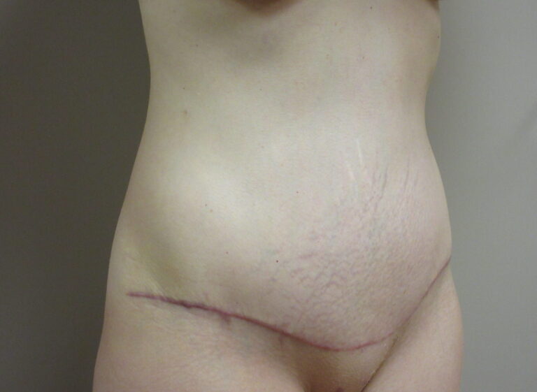 After Image: Tummy Tuck Patient 63 - right-front-oblique