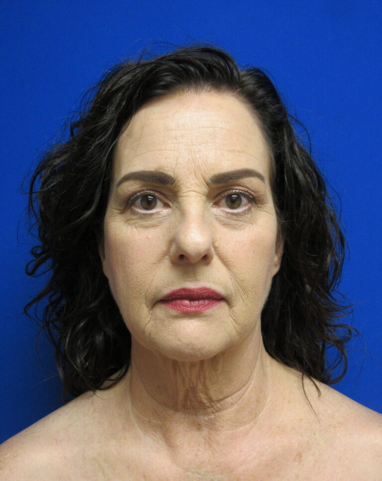 Before Image: Facelift Patient 4 - front