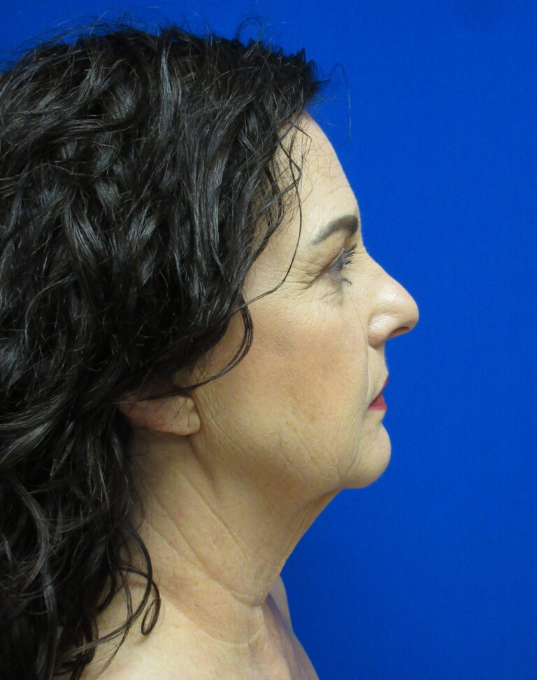 Before Image: Facelift Patient 4 - right-side