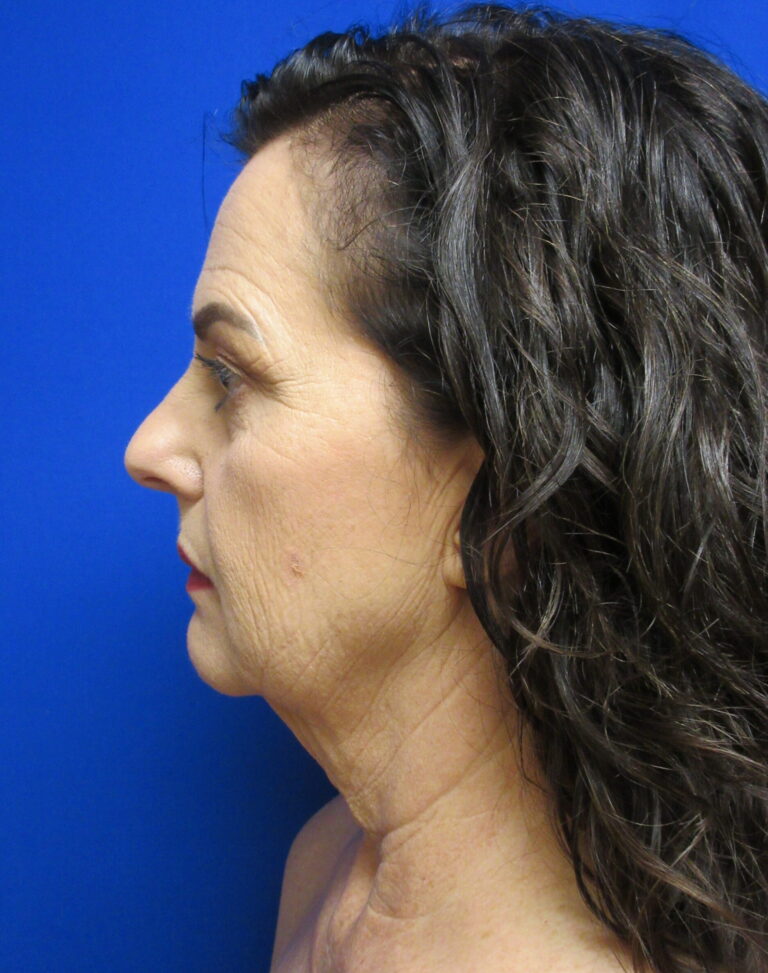Before Image: Facelift Patient 4 - left-side