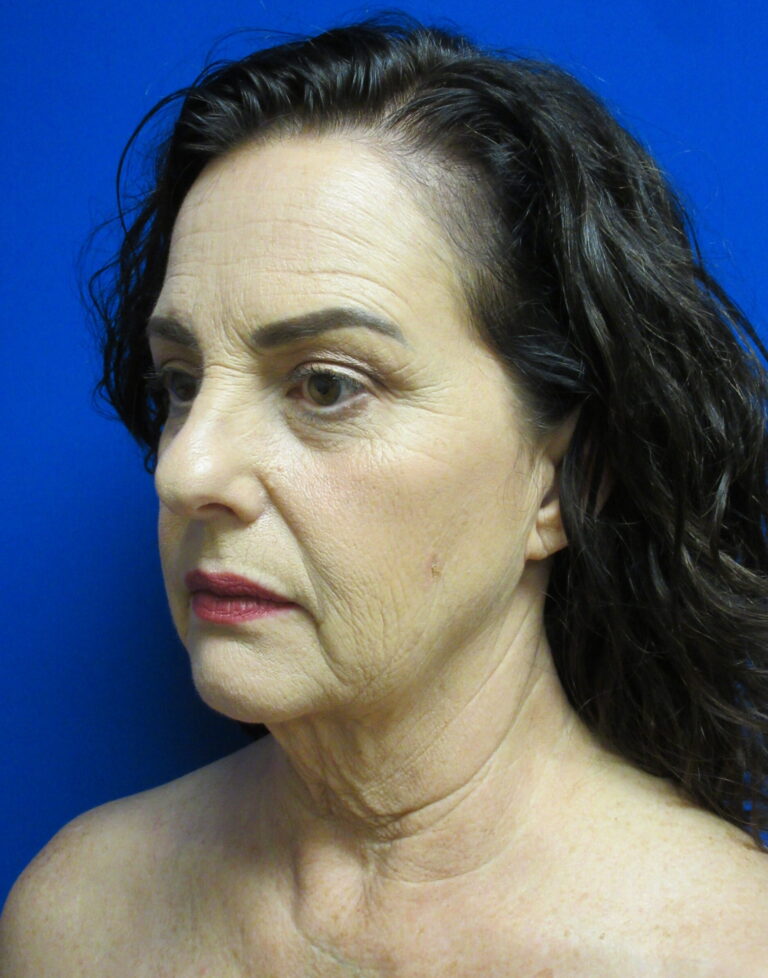 Before Image: Facelift Patient 4 - left-front-oblique
