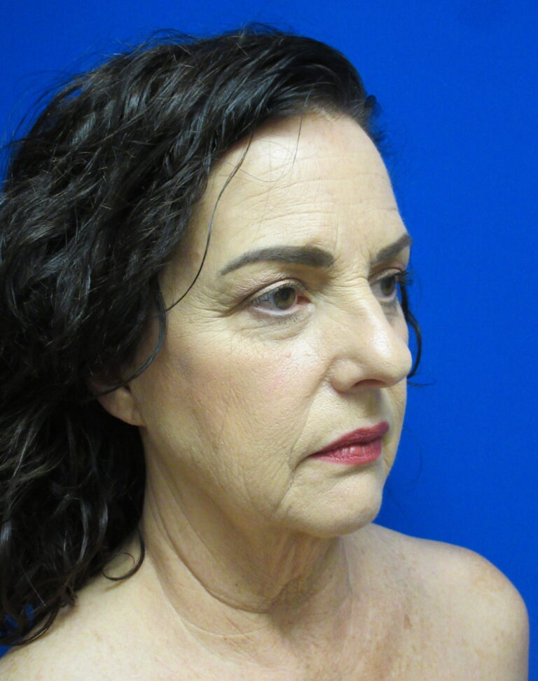 Before Image: Facelift Patient 4 - right-front-oblique