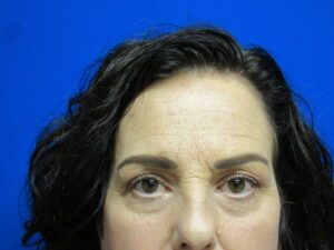 Before Image: Browlift Patient 6