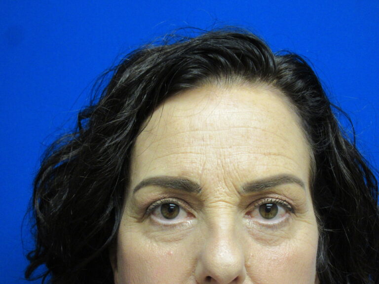 Before Image: Browlift Patient 6 - front