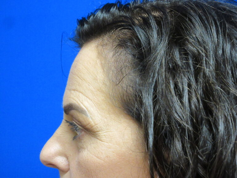 Before Image: Browlift Patient 6 - left-side