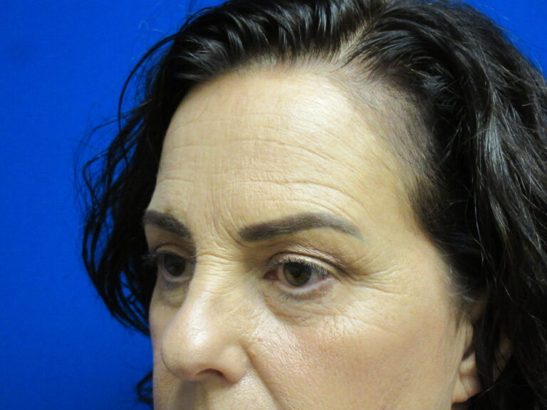 Before Image: Browlift Patient 6 - left-front-oblique