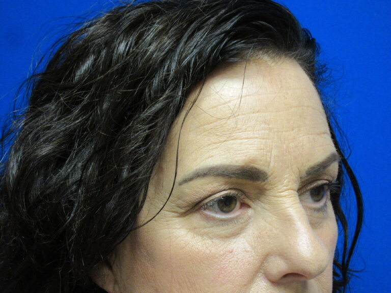 Before Image: Browlift Patient 6 - right-front-oblique