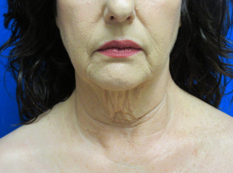 Before Image: Neck Lift Patient 7 - front