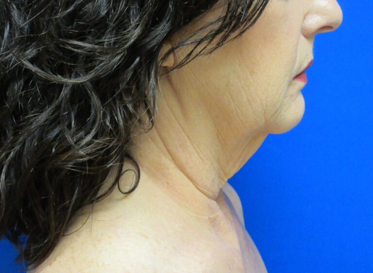 Before Image: Neck Lift Patient 7 - right-side