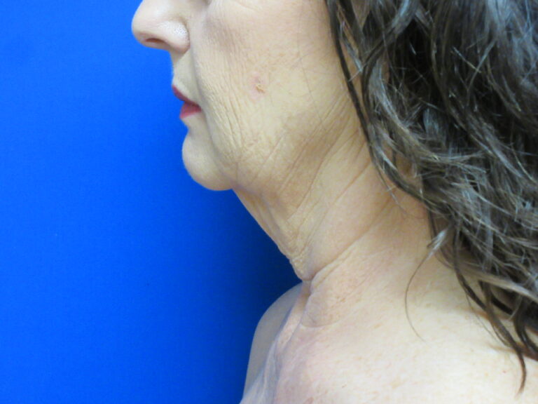 Before Image: Neck Lift Patient 7 - left-side