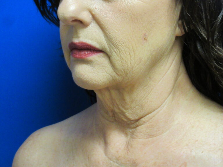 Before Image: Neck Lift Patient 7 - left-front-oblique