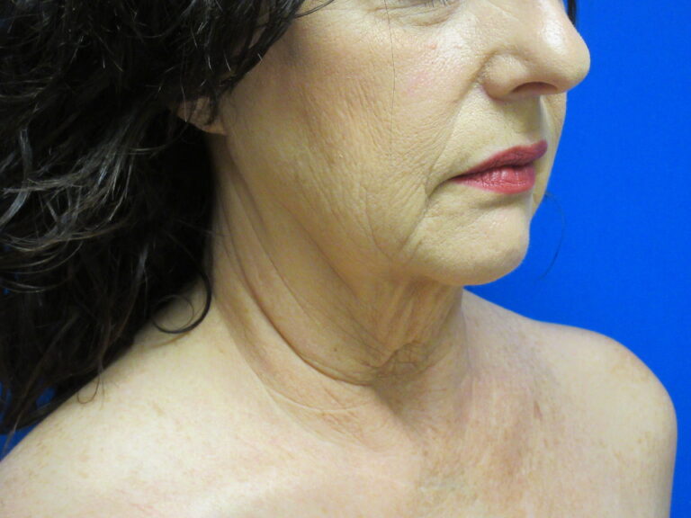 Before Image: Neck Lift Patient 7 - right-front-oblique