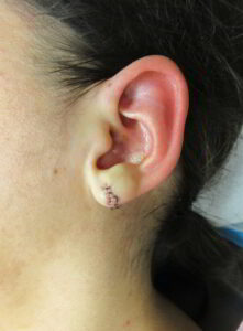Before Image: Earlobe Repair Patient 1