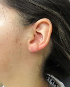 After Image: Earlobe Repair Patient 1
