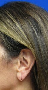 Before Image: Earlobe Repair Patient 2