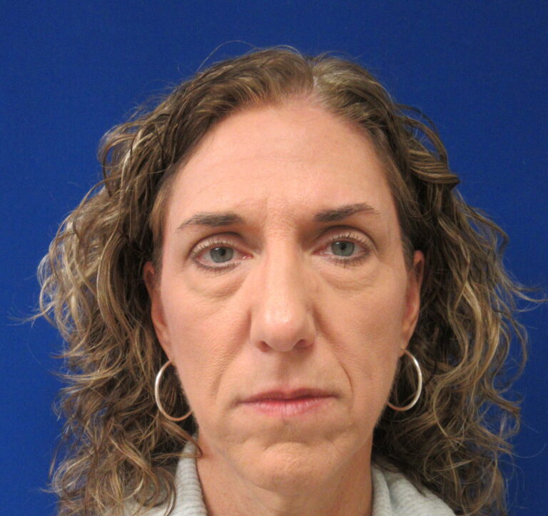Before Image: Blepharoplasty Patient 16 - front