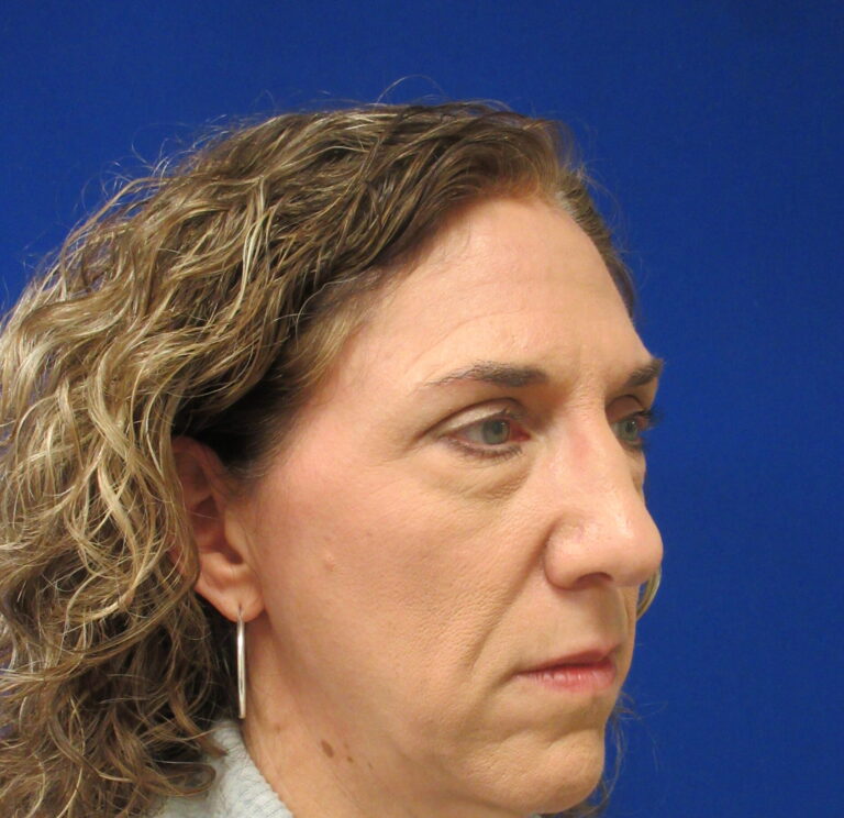 Before Image: Blepharoplasty Patient 16 - right-front-oblique