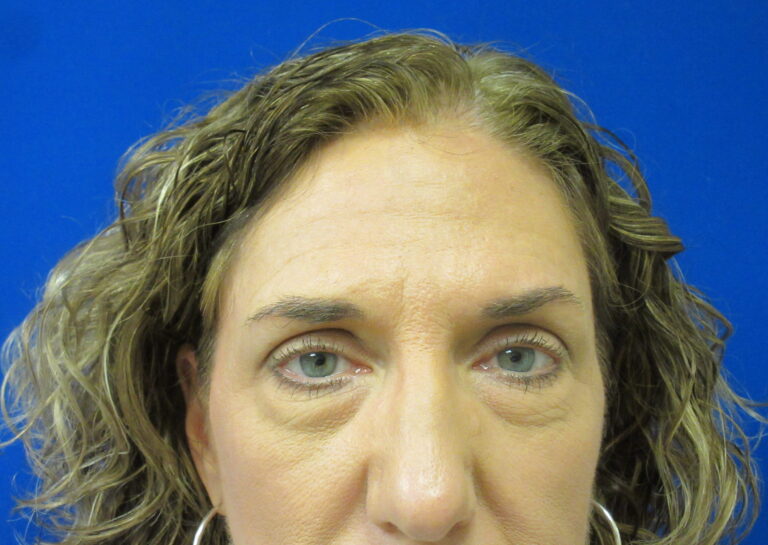 Before Image: Blepharoplasty Patient 16 - front