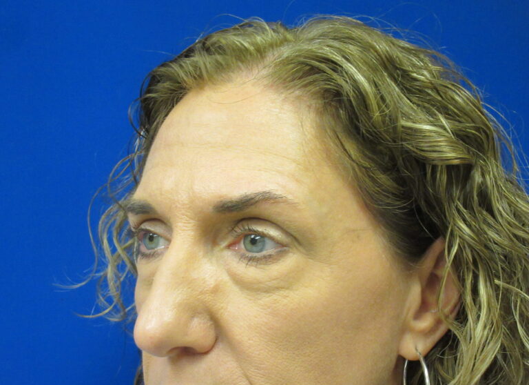 Before Image: Blepharoplasty Patient 16 - left-front-oblique